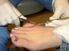 Removing stitches