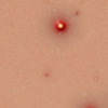 Acne 1